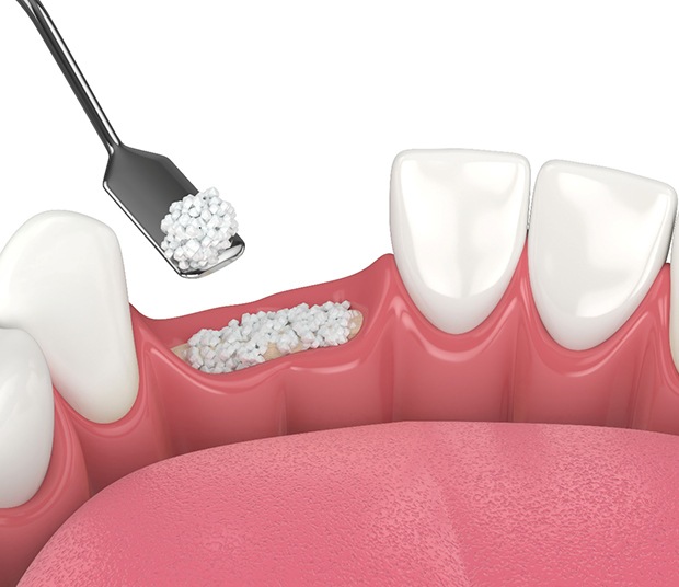 Illustration of bone grafting in Dallas for lower arch