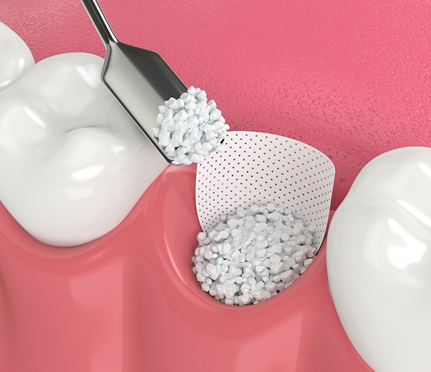 Illustration of bone grafting after a tooth extraction
