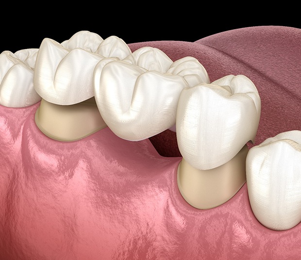 Illustration of dental bridge in Dallas, TX being placed