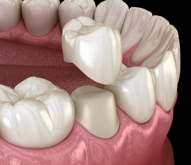 Animated smile during dental crown placement