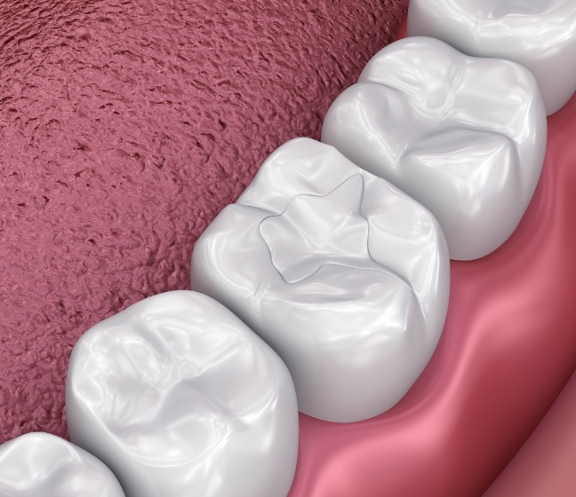 Animated smile with dental sealants