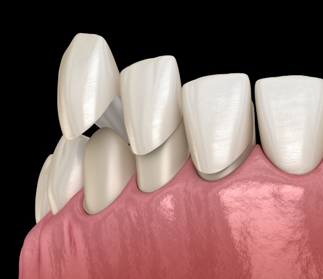 Animated smile during dental bonding treatment