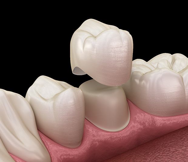 Before and after dental crown in Dallas