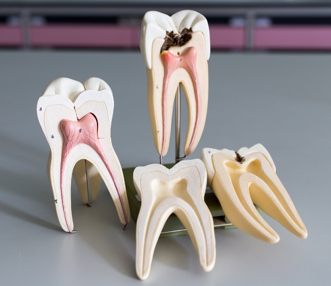 Model of healthy tooth compared with model tooth in need of root canal therapy