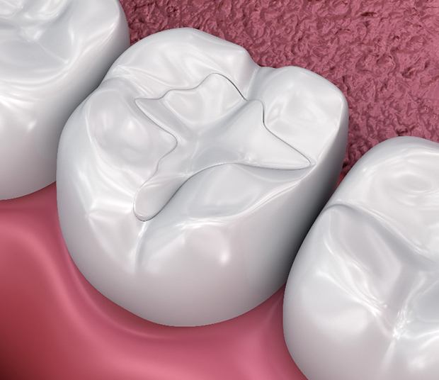 A woman about to receive tooth-colored fillings in Dallas