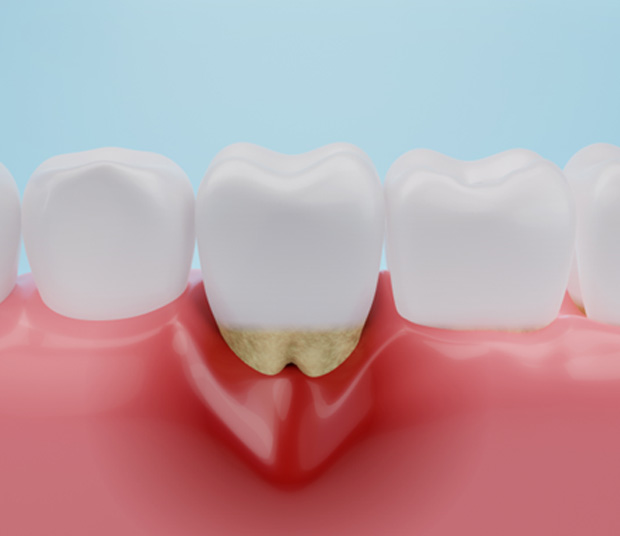 A 3D rendering of inflamed gum tissue