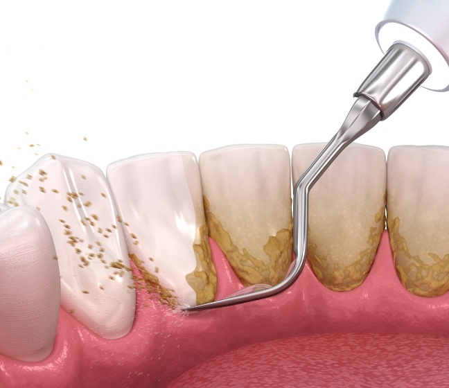 Animated smile during scaling and root planing periodontal disease treatment