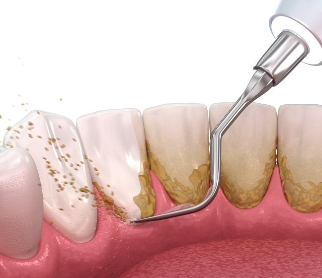 Animated smile during scaling and root planing periodontal disease treatment