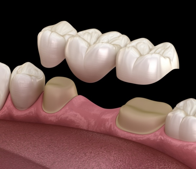 Animated smile during dental bridge placement