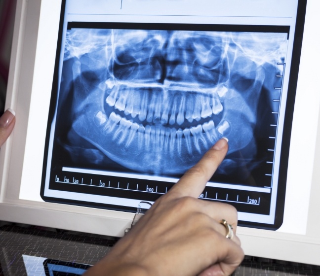 Digital dental x-rays on chairside computer