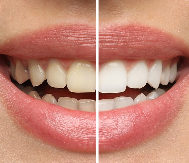Closeup of patient's teeth before and after teeth whitening