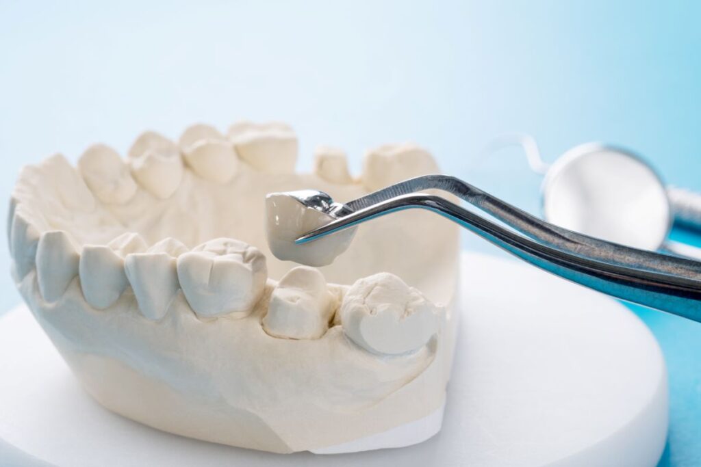 A dental crown being placed on a plaster model of a jaw