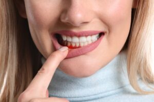 Woman showing red gums. 