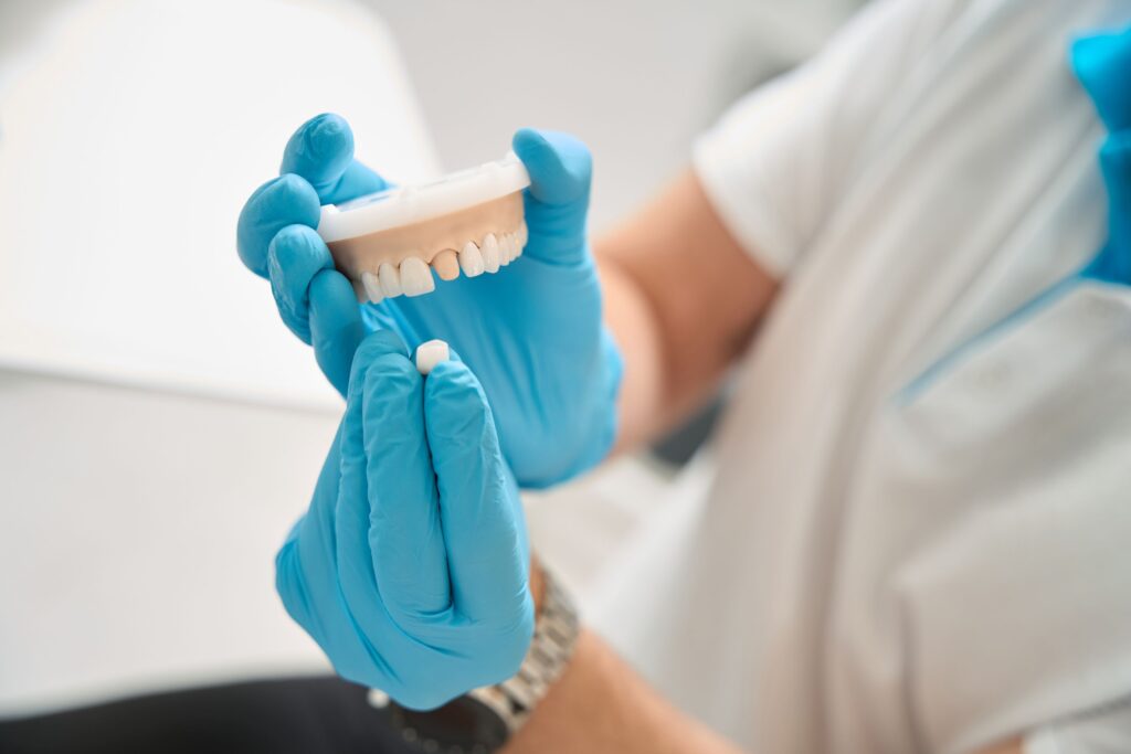 Blue-gloved hands placing sample dental crown over model abutment tooth